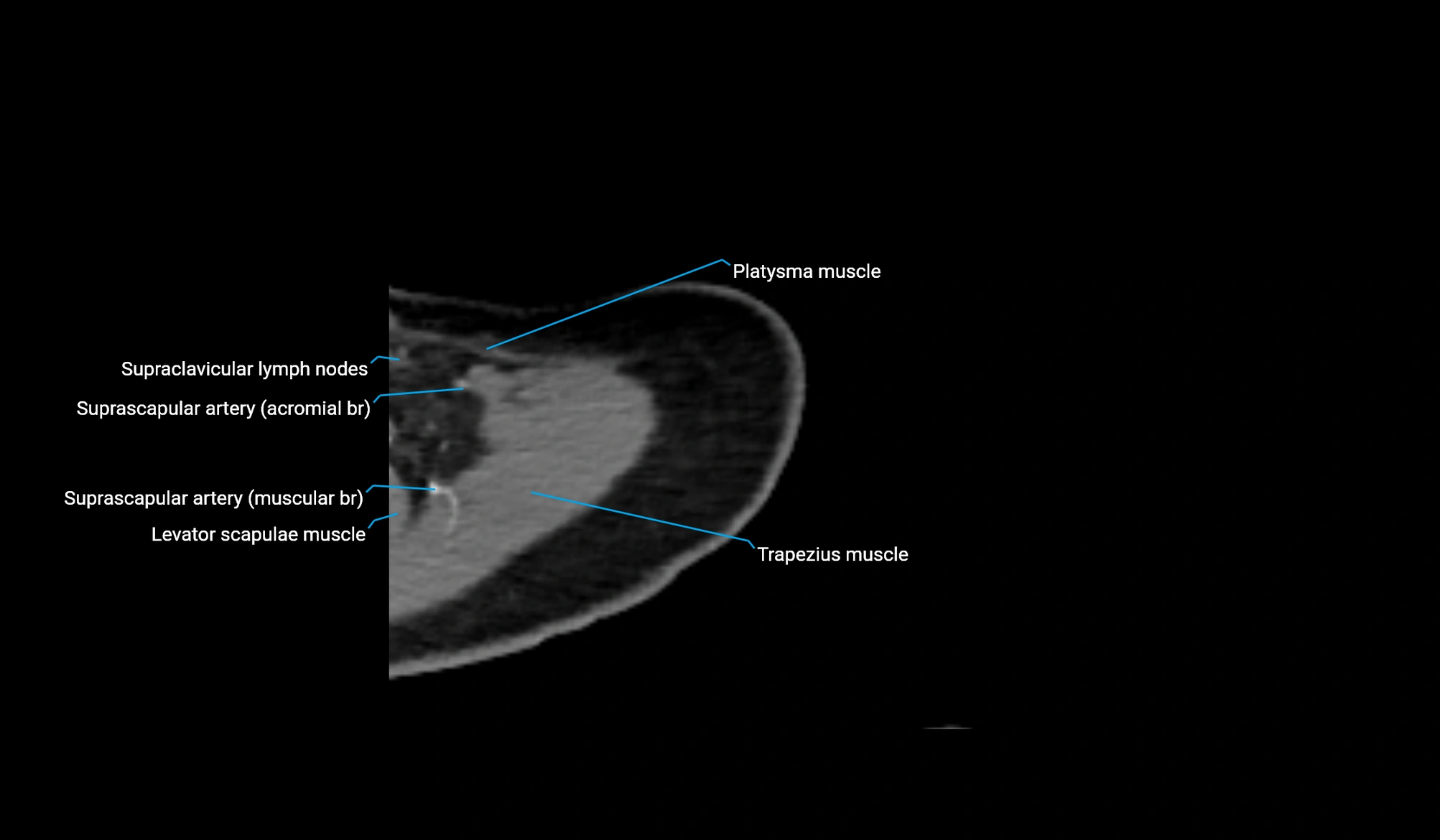 CT upper arm axial  cross sectional anatomy labelled radiology image -00048.webp